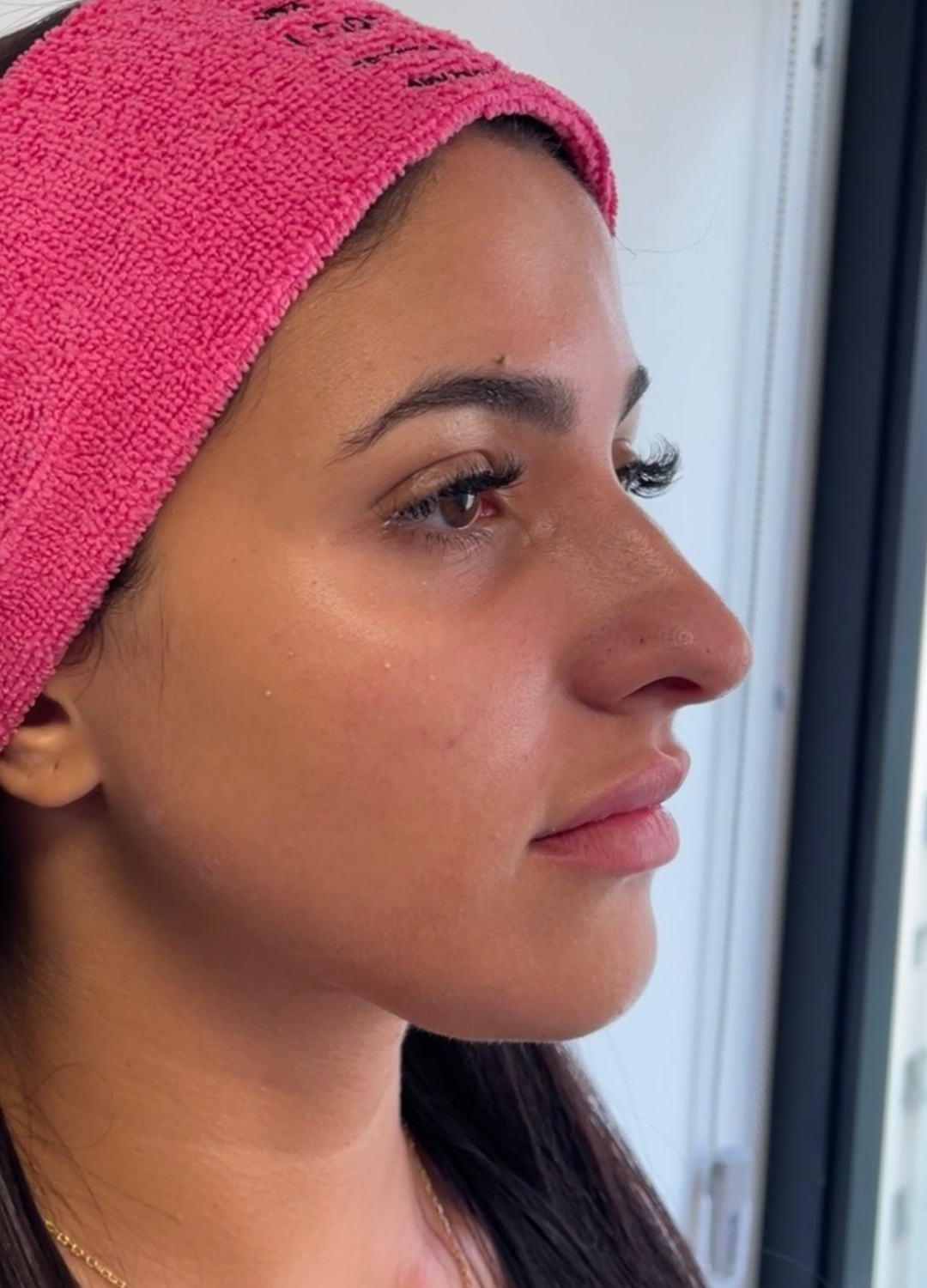 Preenchimento Labial (Cacau) — antes