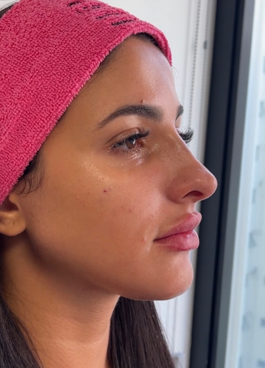 Preenchimento Labial (Cacau) — depois