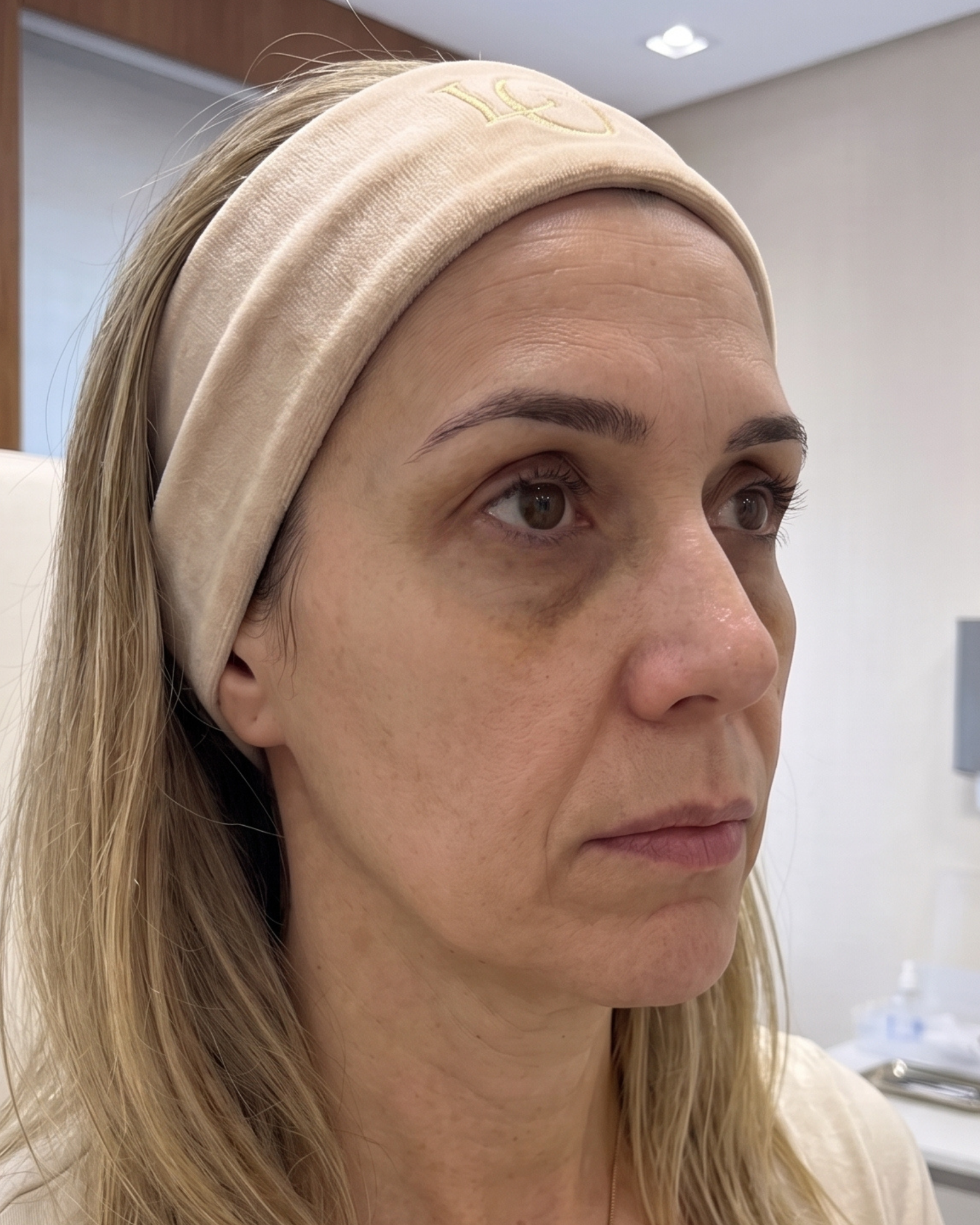 Antes e depois — antes