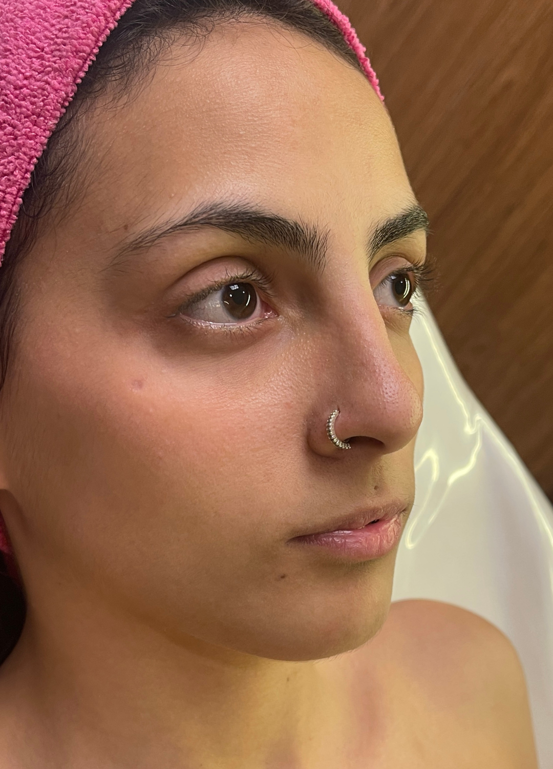 Preenchimento Labial (Paloma) — antes